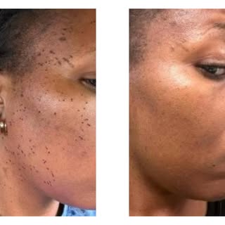 ✨ SAY GOODBYE TO PESKY SPOTS! ✨

Ready to embrace flawless, clear skin again? For the first time eve