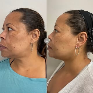 ✨Bright and Tight Laser WITH Salmon DNA✨

Just two weeks apart