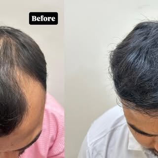 REAL PATIENT • REAL RESULTS • REAL CONFIDENCE
A natural-looking frontal hairline transformation just
