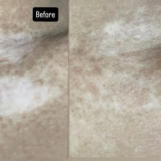 ✨ Vitiligo Treatment Result – Before & After ✨

Witness the remarkable improvement in pigmentation a