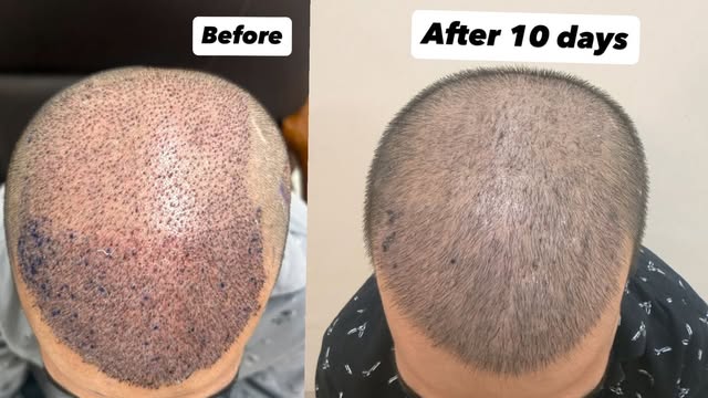 ✨ 10 Days After Hair Transplant — A Natural-Looking Hairline! ✨

A closer look at the 10-day post-tr