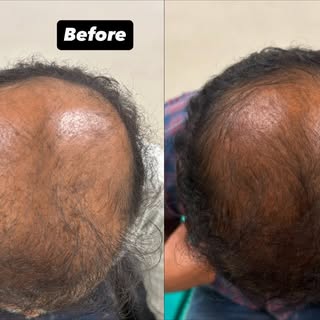 Visible Hair Regrowth Results ✨

Significant improvement in mid-frontal and vertex areas with a comp