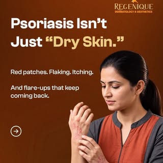 Psoriasis is more than dry, flaky skin. It’s a chronic skin condition that can cause recurring redne