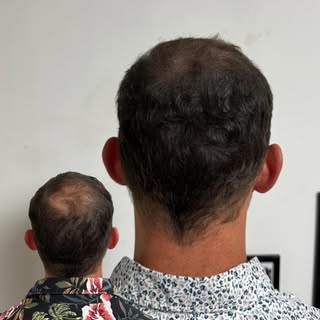 Effet densité sur le vertex 😎

#micropigmentationcapillaire #tricopigmentation #effetdensité #calvi