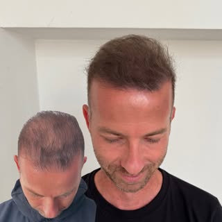 Effet densité post greffe 🔥 

#micropigmentationcapillaire #tricopigmentation #effetdensité #greffe