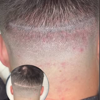 1st session results 
✨ Can Scalp Micropigmentation (SMP) Camouflage Scars? ✨

Absolutely! Scalp Micr