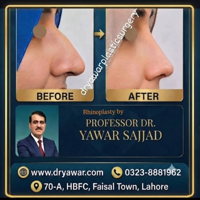 Nose Cosmetic Surgery Transformation – Confidence Restored! 

Witness the amazing before-and-after r