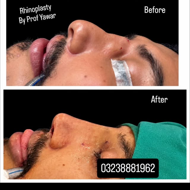 Nose Cosmetic Surgery Transformation – Confidence Restored! 

Witness the amazing before-and-after r