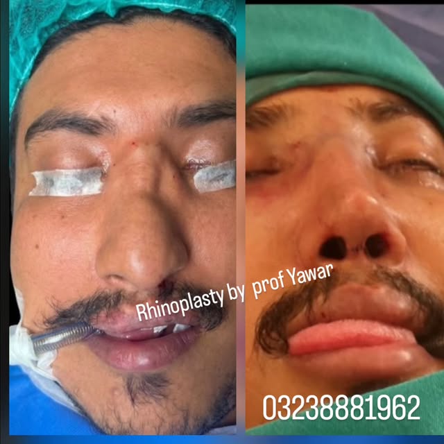 Nose Cosmetic Surgery Transformation – Confidence Restored! 

Witness the amazing before-and-after r