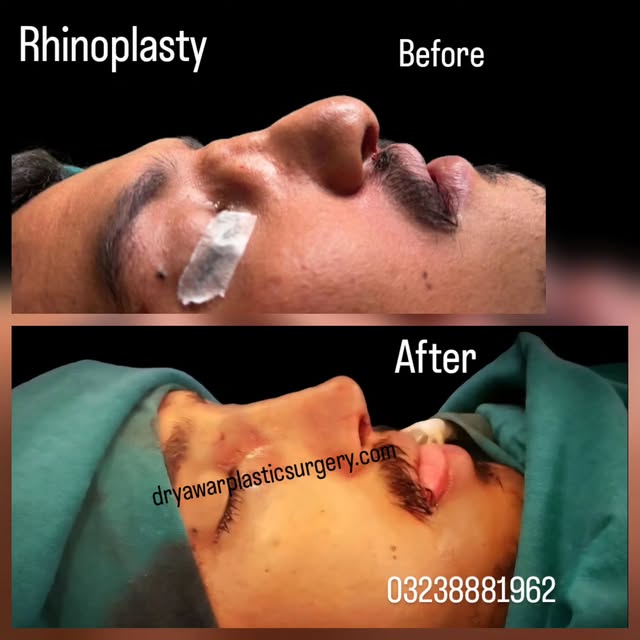 Nose Cosmetic Surgery Transformation – Confidence Restored! 

Witness the amazing before-and-after r