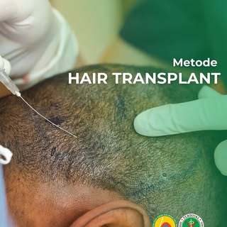 Rambut tipis bukan lagi masalah! Dengan metode Hair Transplant, rambut dipindahkan dari area sehat k