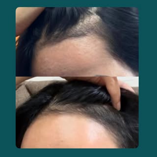 Tidak semua pengobatan kerontokan/penipisan rambut: transplant 🧐

Obat topikal/oles, obat minum, te