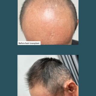 Steady progress at 4 months post hair transplant. Still more growth to come ✨ — final results are us