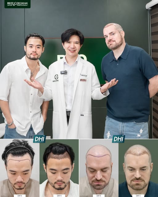 มาปลูกผมคนเดียวอาจจะเหงา…งั้นชวนเพื่อนมาปลูกด้วยกันเลยครับ 😎

สองคน สอง Hairline
เพราะรูปหน้า และปั