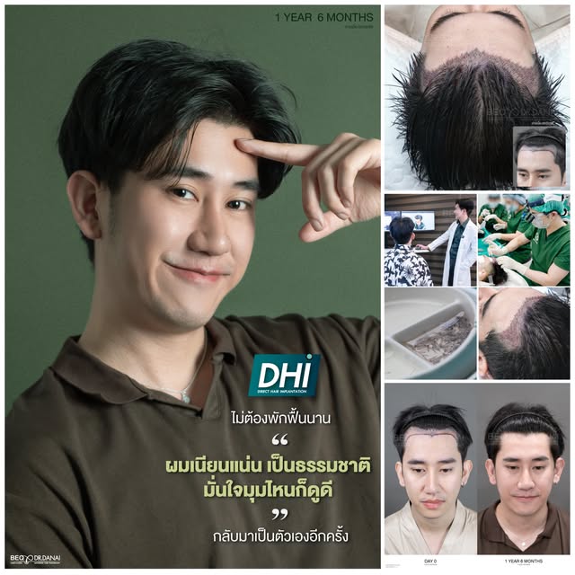 1 ปี 6 เดือนแล้วครับ จากเดิมแนวผมถอยค่อนข้างชัด พอปลูก DHI แล้ว ผมขึ้นแน่น และกลืนกับผมเดิมดีมากครับ