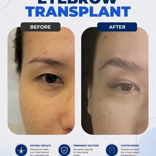 Eyebrow transplant is a personalized procedure designed to restore fullness with natural-looking, lo