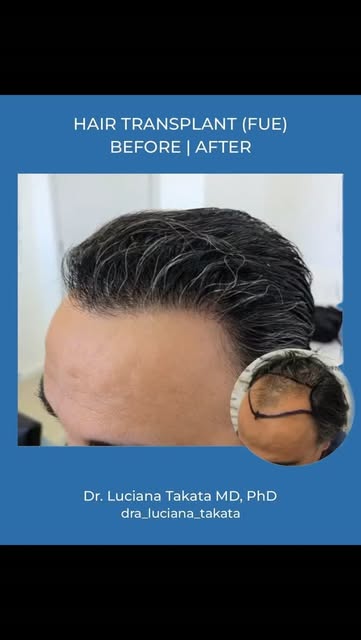 6 months after his FUE hair transplant, my patient came back sharing the comments he keeps hearing:
