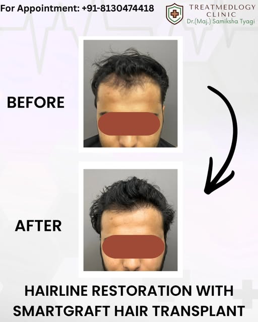 Hairline Restoration in Noida | Smartgraft Hair Transplant
This before & after showcases natural-loo