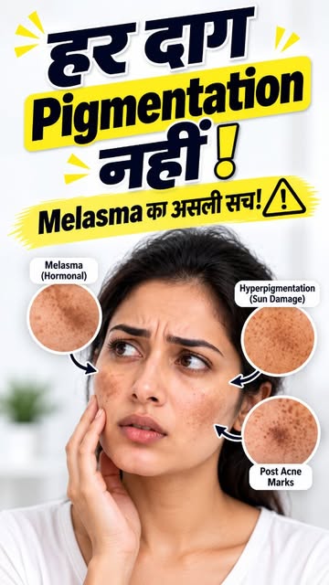 😱 चेहरे के दाग-धब्बे या छाइयां?
हर Dark Spot सिर्फ Pigmentation नहीं होता! 👀
Brown Patches बार-बार