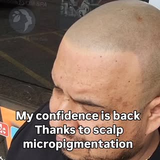How SMP Changed My Life ✨
I used to avoid mirrors and photos because of my thinning hair. It affecte