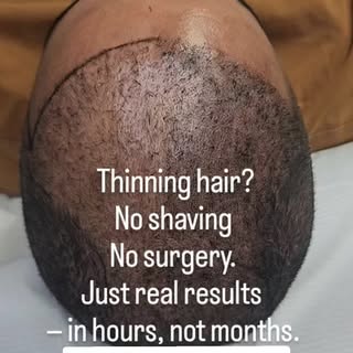 ✨ Boost Your Hair Density Without Shaving ✨
No buzz cut. No downtime. Just thicker-looking hair and 