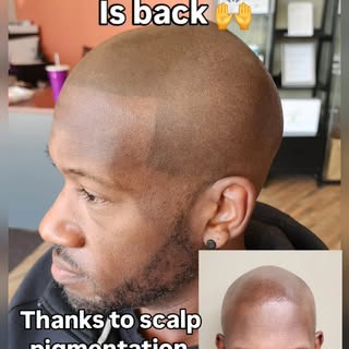 Me before SMP: “I’m not bald, I’m aerodynamic.”
Me after SMP: “Damn, I look good from every angle!” 