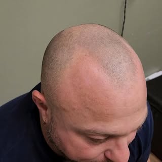 For a long time, I covered up my baldness with a hat... but those days are behind me.

If you’re fac