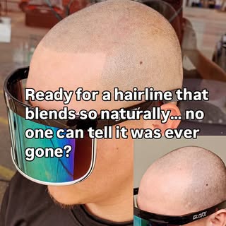 What if your hairline looked like it never disappeared?

Scalp Repigmentation at OM SPA restores a s