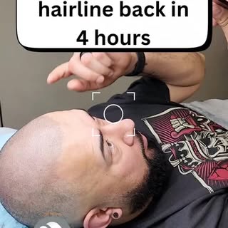 I didn’t expect it to look THIS natural

Zero pain. Zero fake look. Just confidence back.

This is w