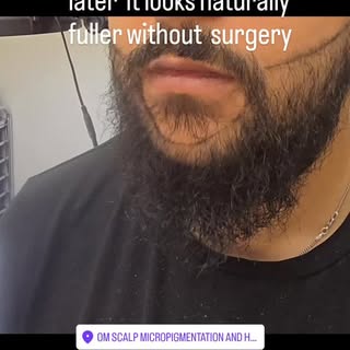 Patchy or uneven beard growth makes your jawline look softer than it should

Beard Density Pigmentat