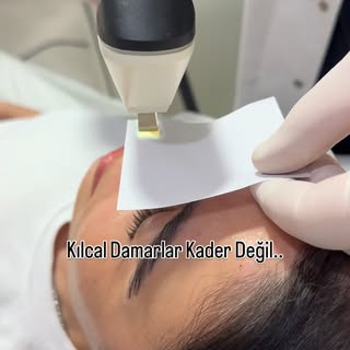 Uygun hasta seçimi ve doğru parametrelerle yapılan lazer uygulamaları sayesinde:
• Yüzeyel damar gör
