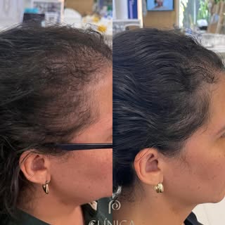 Essa paciente passou por uma cirurgia bariátrica e, no pós-operatório, enfrentou uma queda capilar i