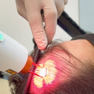 O folículo ainda pode ter potencial!

Mesmo quando o cabelo já está mais fino, ralo ou com sinais de