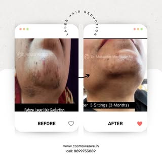 We are thrilled to share the before and after picture of one of our young female patients who underw
