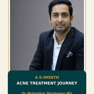 From severe pustular and nodular acne to remarkable clinical improvement over six months.

After con