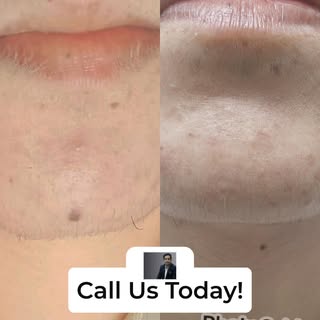 Struggling with uneven skin tone or dark patches this monsoon season?

Pigmentation and melasma ofte