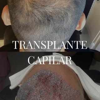 Pós transplante capilar: o primeiro passo foi dado.
Agora seguimos acompanhando a evolução.
O result