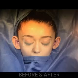 Otoplasty, or ear-pinning, can provide life changing results, relieving patients from self conscious
