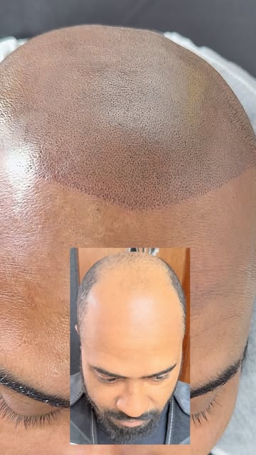 A micropigmentação capilar é um procedimento estético pouco invasivo, no qual se aplica pigmento pró