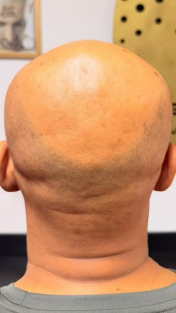 🧵Micropigmentação Capilar Fio a Fio 4T com hiper-realismo e naturalidade é só aqui. 
Tá rolando uma