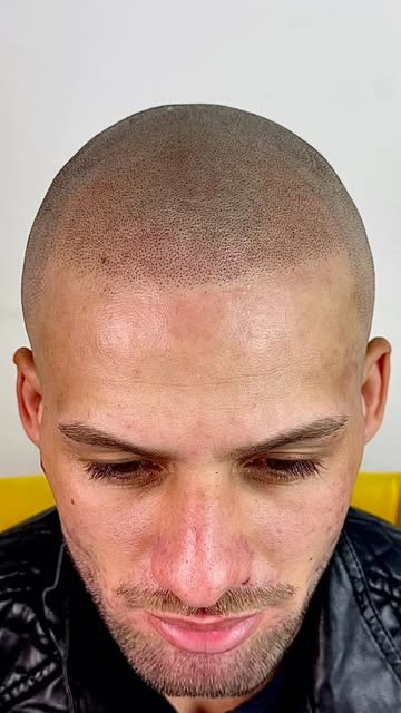 A micropigmentação capilar é um procedimento estético pouco invasivo, no qual se aplica pigmento pró