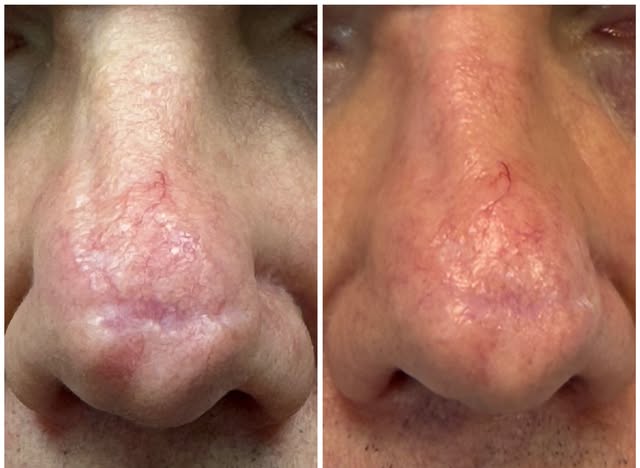 Before and after ablative laser resurfacing..Post surgical scar!!
#ablativelaser #happywithresults #
