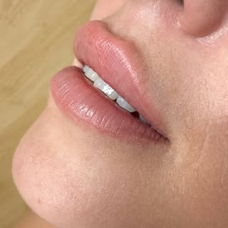 #naturallips #terni #juvedermlips #lipfiller #medicinaestetica 💋💉