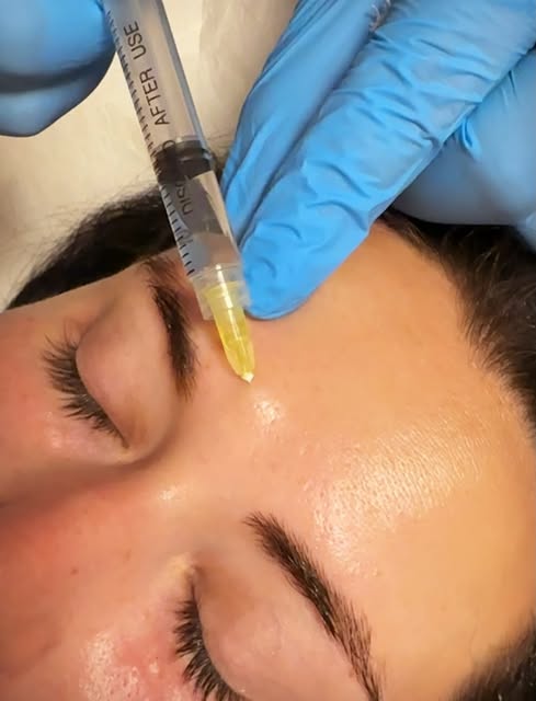 Biovitalizzazione: Un boost di idratazione e luminosità profonda per il tuo viso. Idrata, distende e