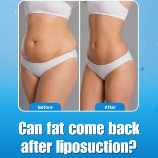 Can Fat Come Back After Liposuction?

One of the most common questions about liposuction is whether 