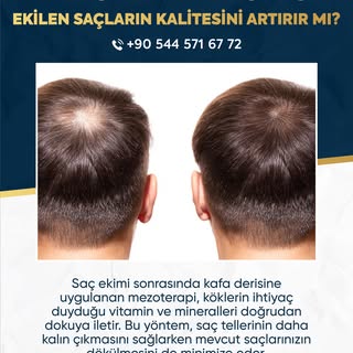 ✨ Mezoterapi Desteği Ekilen Saçların Kalitesini Artırır Mı? ✨

Saç ekimi sonrasında kafa derisine uy