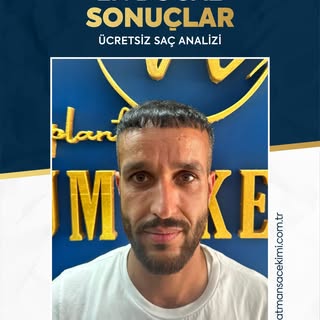 ✨ En Doğal Sonuçlar ✨

Saç ekiminde en büyük başarı, sonucun dışarıdan bakıldığında tamamen doğal du