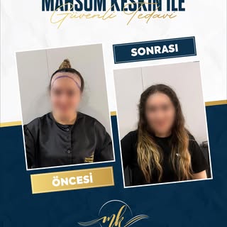 ✨ Mahsum Keskin İle Güvenli Tedavi ✨

Doğru saç çizgisi planlaması ve kişiye özel hassas bir ekim sü