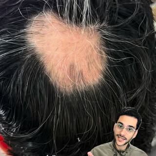 É um assunto delicado que poucas pessoas sabem. Mas a Alopecia areata me acompanha há anos e só aume