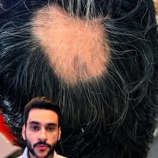 O tratamento de alopecia areata com o @dr.julioportes vai muito bem graças a Deus. Caso passem pelo 